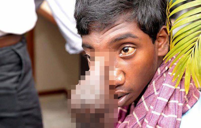 Индийскому подростку удалили мошонку со лба