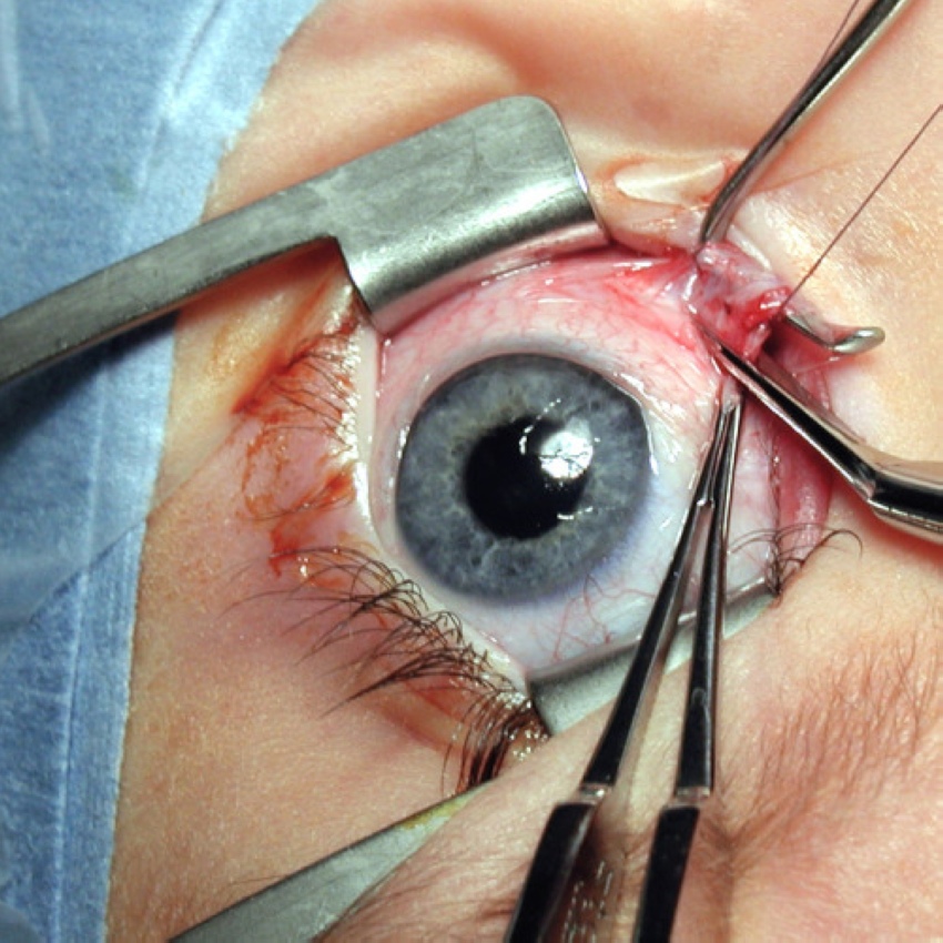 Как делают операции на глазах